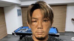 「大丈夫ですか？！」皇治、顔面に異変で“フジモン”化？　腫れ上がった右目に「男らしくてかっこえぇ」「痛そうです」